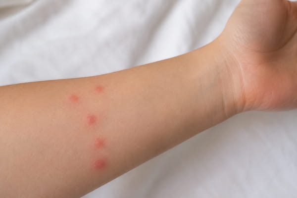 ujed stenice po ruci
